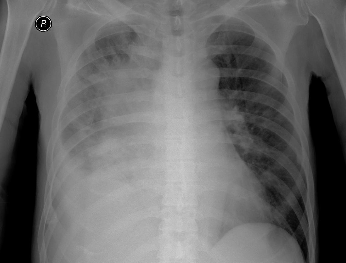 icd 10 code for copd with acute exacerbation